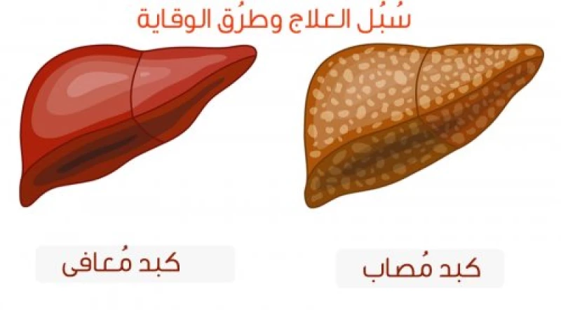 انــســف دهون الكبد كلها.. أعشاب تحمي خلايا الكبد وتمنعه من التليف!! هذا المشروب يجدد خلايا الكبد وأنزيماته